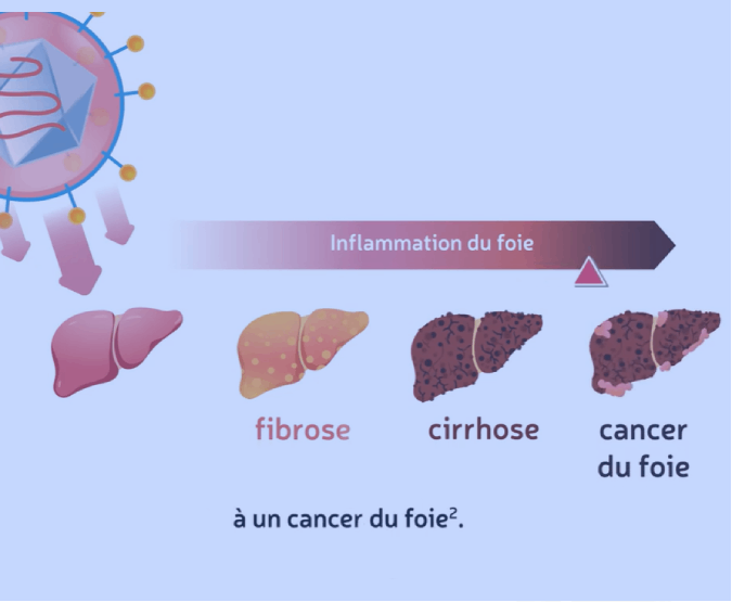 hepatite c